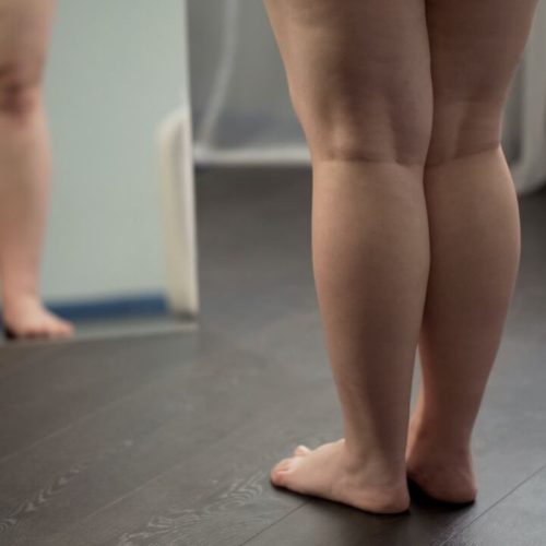 lipedema o que é?